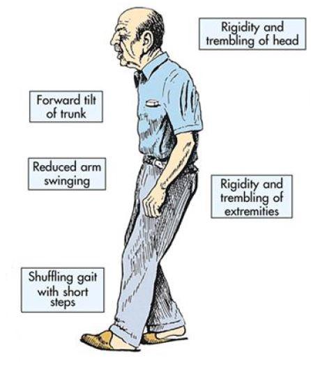 Parkinson j an essay on the shaking palsy